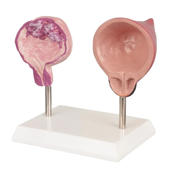 Human Bladder Model Set Normal Vs Smoking-Induced Changes for Educational Purposes