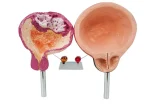 Human Bladder Model Set Normal Vs Smoking-Induced Changes for Educational Purposes