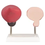 Human Bladder Model Set Normal Vs Smoking-Induced Changes for Educational Purposes