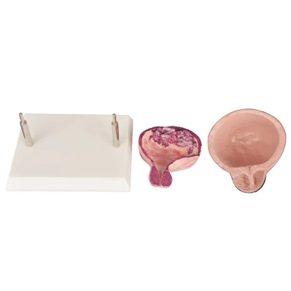 Human Bladder Model Set Normal Vs Smoking-Induced Changes for Educational Purposes