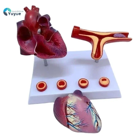 Human Cardiovascular Thrombus & Artery Blockage Anatomical Model Educational Equipment