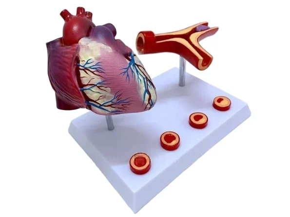 Human Cardiovascular Thrombus & Artery Blockage Anatomical Model Educational Equipment