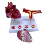 Human Cardiovascular Thrombus & Artery Blockage Anatomical Model Educational Equipment