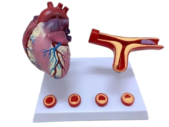 Human Cardiovascular Thrombus & Artery Blockage Anatomical Model Educational Equipment