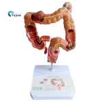 Human Colon Pathological Model - Displays Various Colon & Rectal Diseases