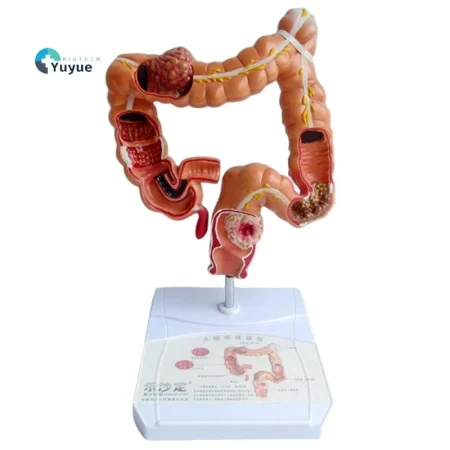 Human Colon Pathological Model - Displays Various Colon & Rectal Diseases