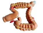 Human Colon Pathological Model - Displays Various Colon & Rectal Diseases