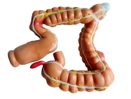 Human Colon Pathological Model - Displays Various Colon & Rectal Diseases