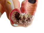 Human Colon Pathological Model - Displays Various Colon & Rectal Diseases