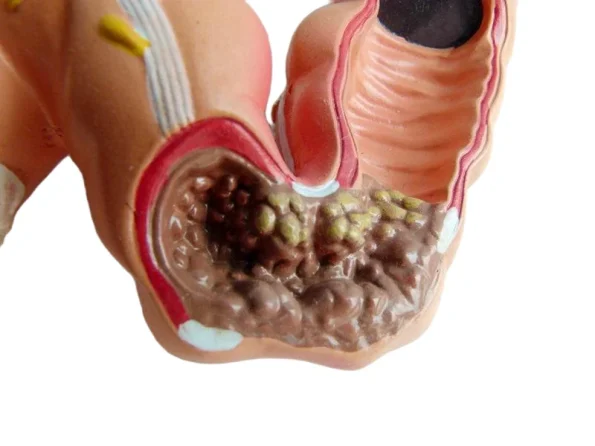 Human Colon Pathological Model - Displays Various Colon & Rectal Diseases