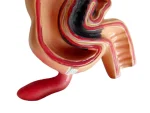 Human Colon Pathological Model - Displays Various Colon & Rectal Diseases