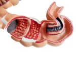 Human Colon Pathological Model - Displays Various Colon & Rectal Diseases