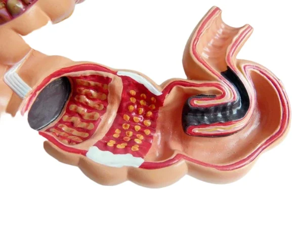 Human Colon Pathological Model - Displays Various Colon & Rectal Diseases