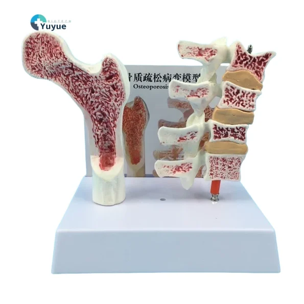 Human Femur Osteoporosis Anatomy Model PVC Leg Bone Cross-Section Spinal Slice Pathological Lumbar Vertebrae for Medical Science