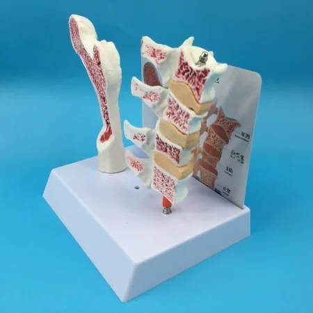 Human Femur Osteoporosis Anatomy Model PVC Leg Bone Cross-Section Spinal Slice Pathological Lumbar Vertebrae for Medical Science