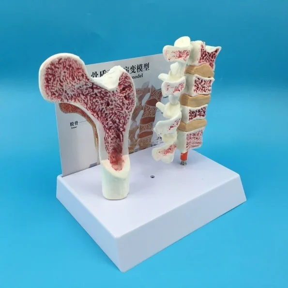 Human Femur Osteoporosis Anatomy Model PVC Leg Bone Cross-Section Spinal Slice Pathological Lumbar Vertebrae for Medical Science