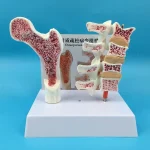 Human Femur Osteoporosis Anatomy Model PVC Leg Bone Cross-Section Spinal Slice Pathological Lumbar Vertebrae for Medical Science