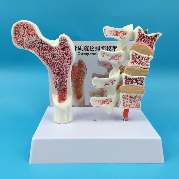 Human Femur Osteoporosis Anatomy Model PVC Leg Bone Cross-Section Spinal Slice Pathological Lumbar Vertebrae for Medical Science