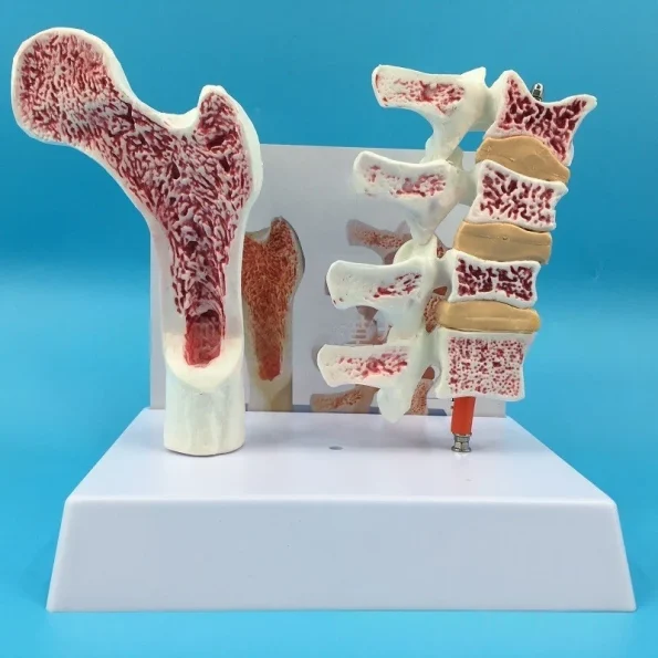 Human Femur Osteoporosis Anatomy Model PVC Leg Bone Cross-Section Spinal Slice Pathological Lumbar Vertebrae for Medical Science