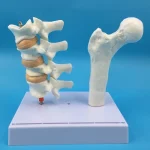 Human Femur Osteoporosis Anatomy Model PVC Leg Bone Cross-Section Spinal Slice Pathological Lumbar Vertebrae for Medical Science