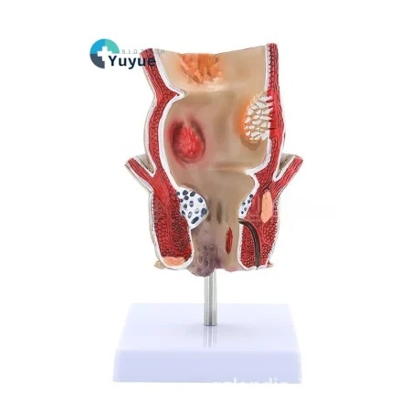 Human Rectum Anatomy Model PVC Medical Science Training Education for Pathological Hemorrhoids Internal External Hemorrhoid