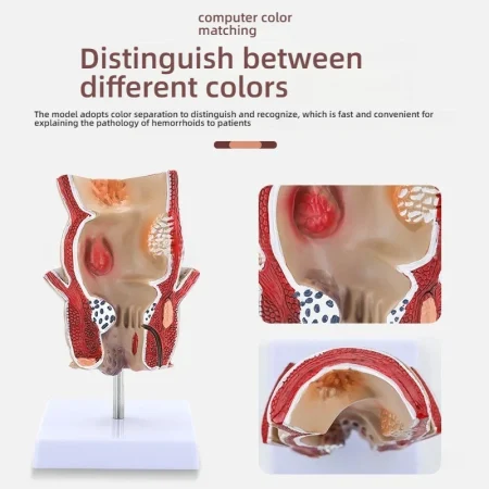 Human Rectum Anatomy Model PVC Medical Science Training Education for Pathological Hemorrhoids Internal External Hemorrhoid
