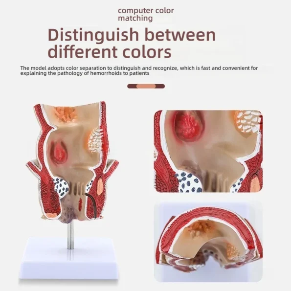 Human Rectum Anatomy Model PVC Medical Science Training Education for Pathological Hemorrhoids Internal External Hemorrhoid