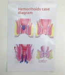 Human Rectum Anatomy Model PVC Medical Science Training Education for Pathological Hemorrhoids Internal External Hemorrhoid