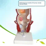 Human Rectum Anatomy Model PVC Medical Science Training Education for Pathological Hemorrhoids Internal External Hemorrhoid