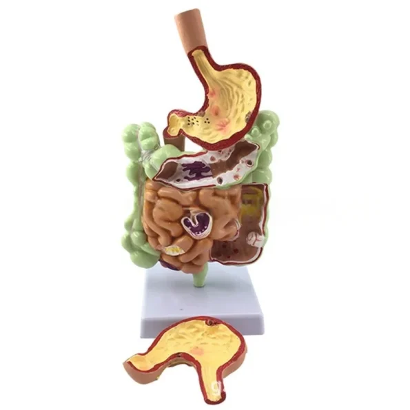 Large Intestine Pathology Model for Human PVC Gastrointestinal Anatomy with Diseased Colon Cecum Rectum Duodenum for Training