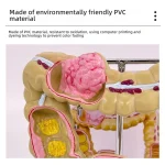 Large Intestine Rectum Disease Specimen Model for Medical Education Plastic Teaching Colon Pathology Tool for Doctor-Patient