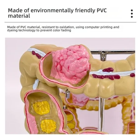 Large Intestine Rectum Disease Specimen Model for Medical Education Plastic Teaching Colon Pathology Tool for Doctor-Patient