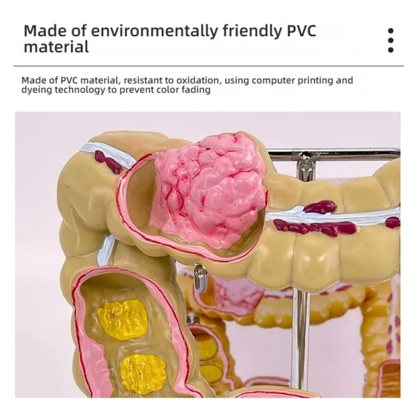 Large Intestine Rectum Disease Specimen Model for Medical Education Plastic Teaching Colon Pathology Tool for Doctor-Patient