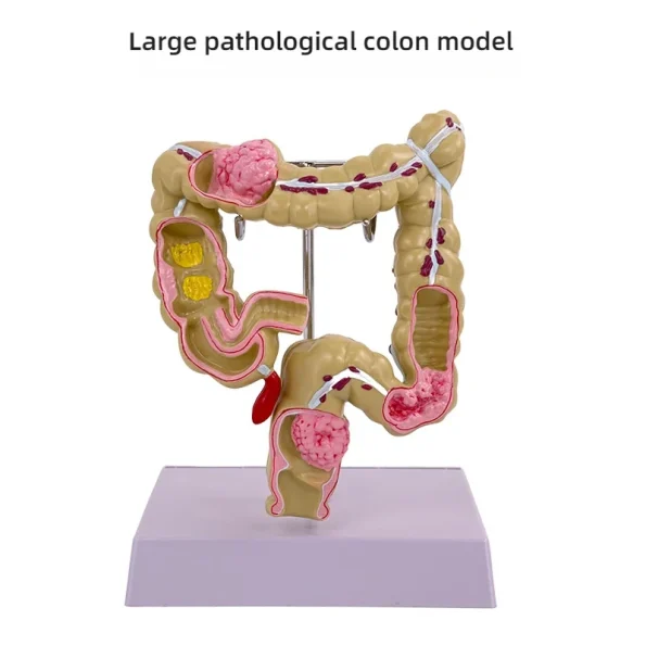 Large Intestine Rectum Disease Specimen Model for Medical Education Plastic Teaching Colon Pathology Tool for Doctor-Patient