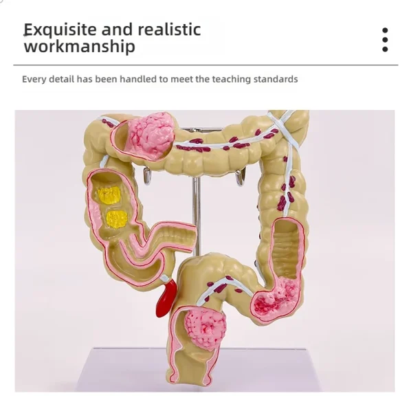 Large Intestine Rectum Disease Specimen Model for Medical Education Plastic Teaching Colon Pathology Tool for Doctor-Patient