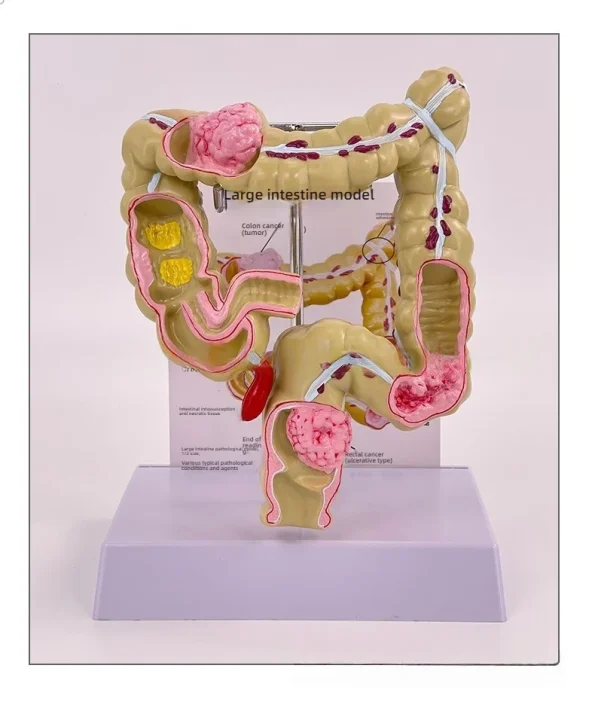 Large Intestine Rectum Disease Specimen Model for Medical Education Plastic Teaching Colon Pathology Tool for Doctor-Patient