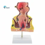 Large Rectal Hemorrhoid Anatomical Model for Medical Education Essential Educational Equipment