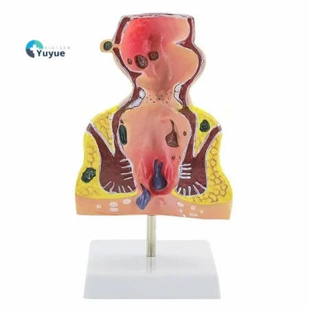 Large Rectal Hemorrhoid Anatomical Model for Medical Education Essential Educational Equipment