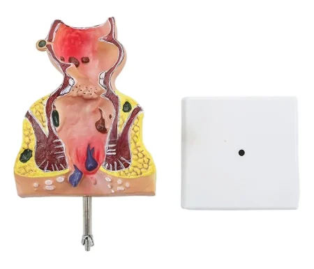 Large Rectal Hemorrhoid Anatomical Model for Medical Education Essential Educational Equipment