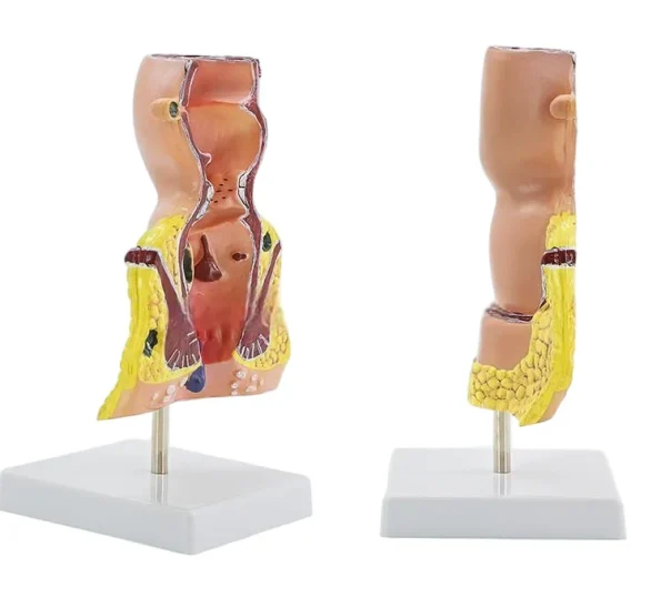 Large Rectal Hemorrhoid Anatomical Model for Medical Education Essential Educational Equipment