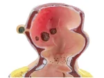 Large Rectal Hemorrhoid Anatomical Model for Medical Education Essential Educational Equipment