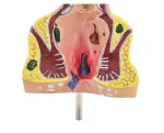 Large Rectal Hemorrhoid Anatomical Model for Medical Education Essential Educational Equipment
