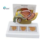 Male Pelvic Cavity Model: Prostate Health & Hyperplasia Stages Demonstration