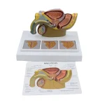 Male Pelvic Cavity Model: Prostate Health & Hyperplasia Stages Demonstration