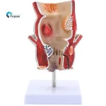 Medical Anatomical Hemorrhoid Model for Pathological Demonstration Enhanced Education and Patient Communication