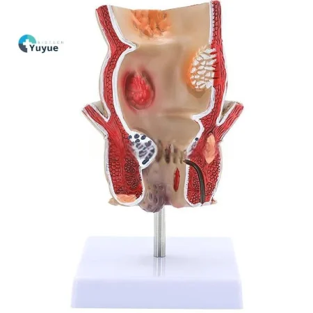 Medical Anatomical Hemorrhoid Model for Pathological Demonstration Enhanced Education and Patient Communication