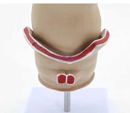 Medical Anatomical Hemorrhoid Model for Pathological Demonstration Enhanced Education and Patient Communication