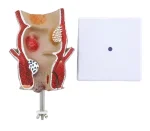 Medical Anatomical Hemorrhoid Model for Pathological Demonstration Enhanced Education and Patient Communication