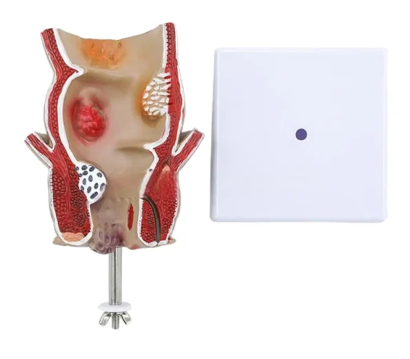 Medical Anatomical Hemorrhoid Model for Pathological Demonstration Enhanced Education and Patient Communication