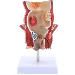 Medical Anatomical Hemorrhoid Model for Pathological Demonstration Enhanced Education and Patient Communication